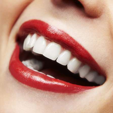 Teeth-Whitening-1.jpg