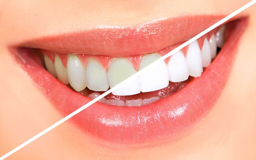 san-jose-teeth-whitening - Crescent Dental