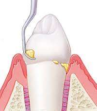 teeth-cleaning.jpg